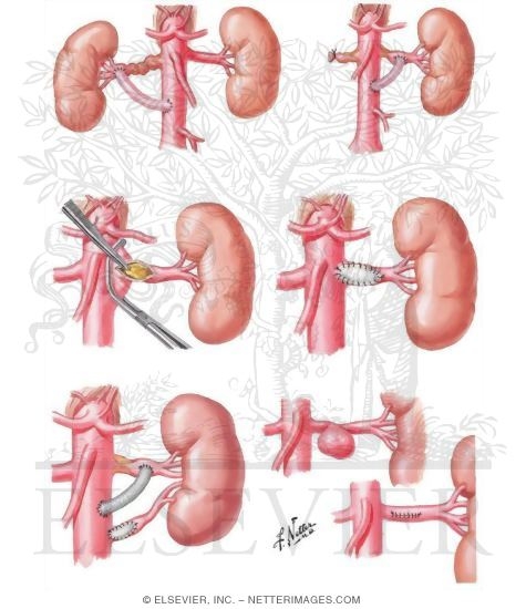 Watermarked preview of unlabeled image: Renal Revascularization