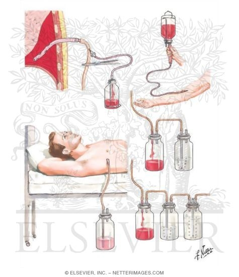 Autotransfusion of Pleural Blood Under-Water-Seal Drainage