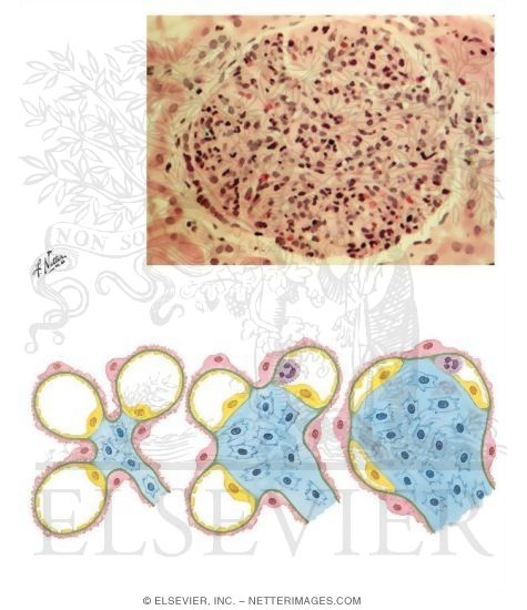 Acute Glomerulonephritis