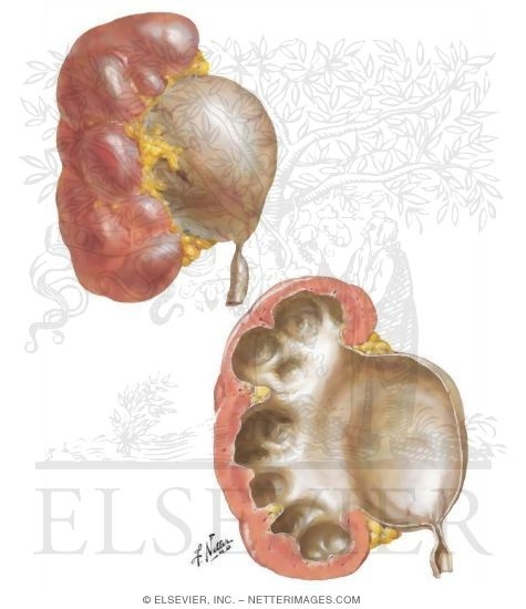 Obstructive Uropathy