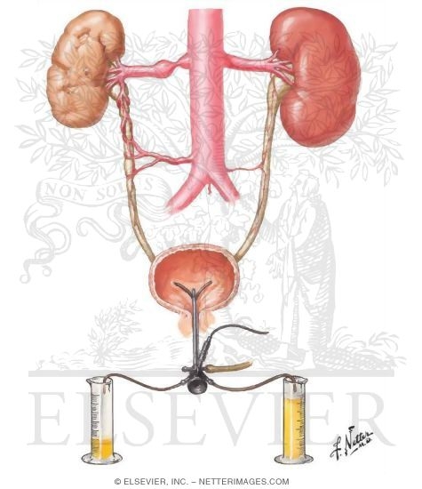 Renal Artery Stenosis