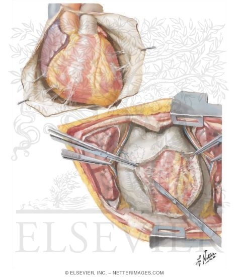 Diseases of Pericardium