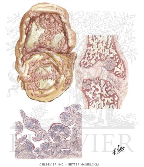 Watermarked preview of unlabeled image: Pathology of Rheumatoid Arthritis