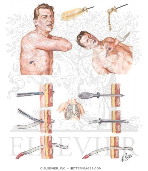 Treatment of Tension Pneumothorax Insertion of Drainage Tubes
