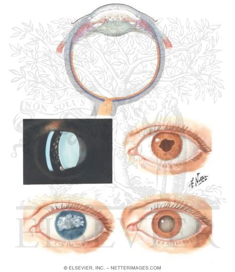 Chronic Iridocyclitis of Juvenile Rheumatoid Arthritis (JRA) Particularly Found In Monarticular Onset