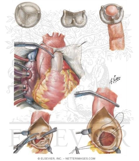 Insertion of Trileaflet Aortic Valve