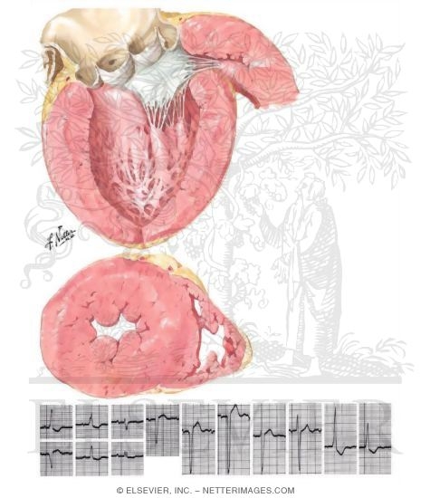 Watermarked preview of unlabeled image: Heart Disease in Hypertension