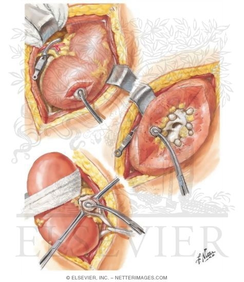 Nephrolithotomy and Pyelolithotomy