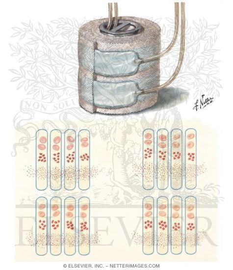 Watermarked preview of unlabeled image: Structure and Function of Twin-Coil Hemodialyzer