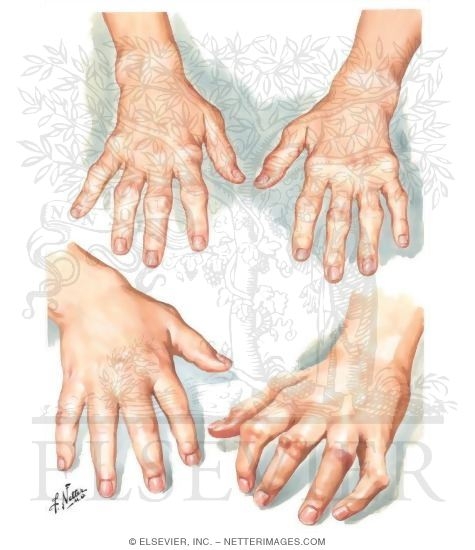 Polyarticular Juvenile Rheumatoid Arthritis