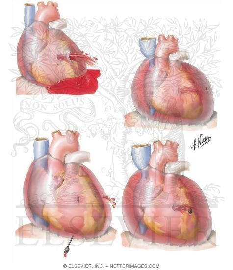 Watermarked preview of unlabeled image: Penetrating Heart Wounds