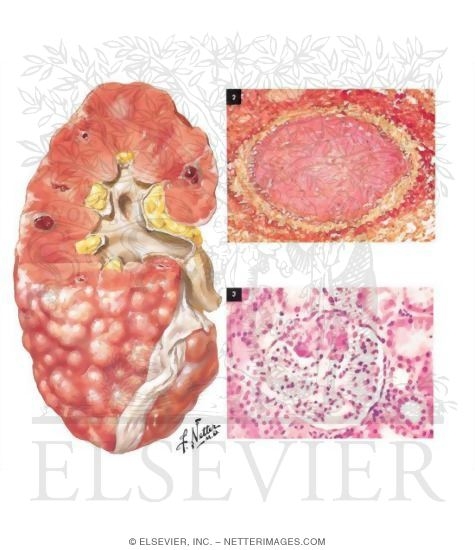 Polyarteritis nodosa: MedlinePlus Medical Encyclopedia