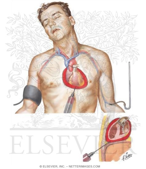 Right Atrium and Ventricle