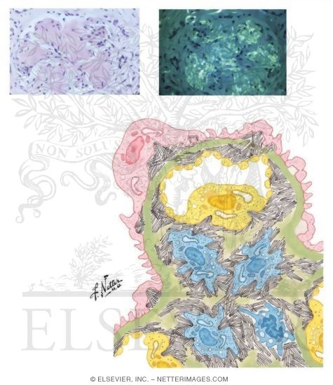 Watermarked preview of unlabeled image: Amyloidosis
