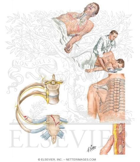 Watermarked preview of unlabeled image: Lower Airway Obstruction Intercostal Nerve Block