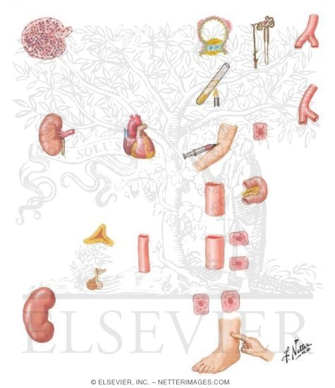 Watermarked preview of unlabeled image: Pathophysiologic Factors in Etiology of Nephrotic Edema