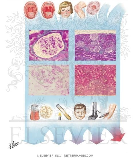 Watermarked preview of unlabeled image: Focal Glomerulonephritis