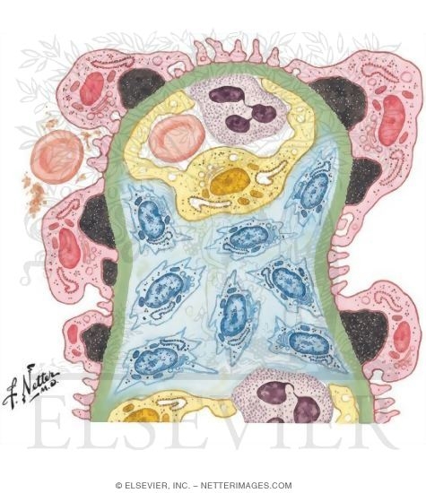 Watermarked preview of unlabeled image: Acute Glomerulonephritis