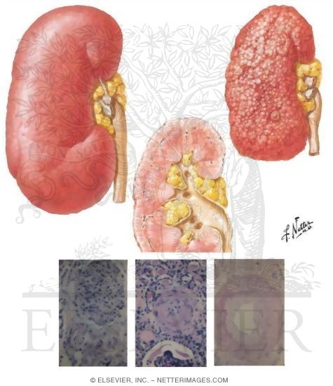 Illustration of Renovascular Hypertension: Benign Essential Hypertension: Renal Pathology from the Netter Collection