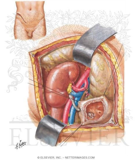 Watermarked preview of unlabeled image: Kidney Transplantation