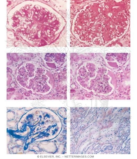 Diabetic Nephropathy: Renal Pathology Related to Diabetic Nephropathy