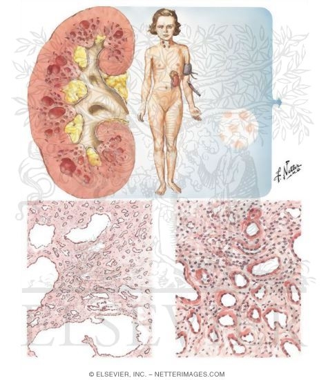 Cystic Disease of Renal Medulla