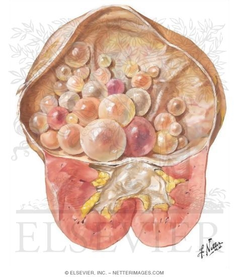 Watermarked preview of unlabeled image: Echinococcus Disease of the Kidney