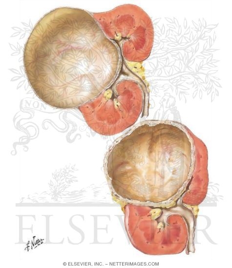 Watermarked preview of unlabeled image: Solitary Cysts of the Kidney