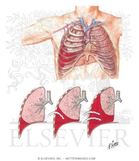 Hemothorax
Sources of Hemothorax