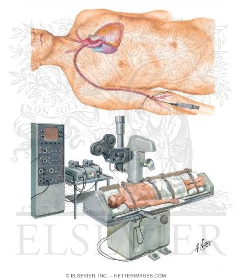 Selective Cine Coronary Arteriography