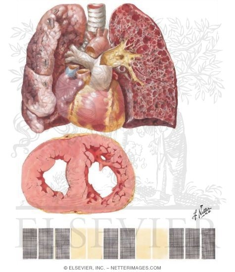 Chronic Cor Pulmonale