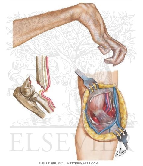 Volkmann's Ischemic Contracture