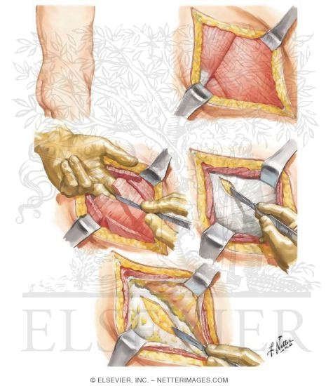 Watermarked preview of unlabeled image: Nephrectomy (Routine Flank Approach)