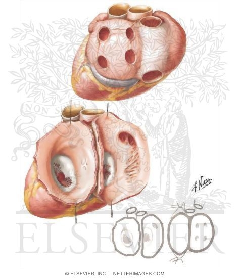 Heart Transplantation - Donor Heart