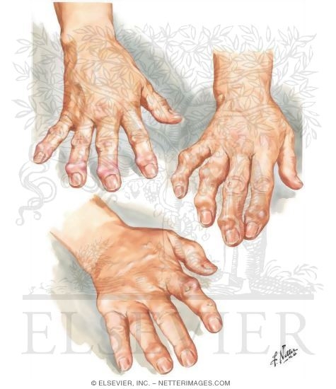 Watermarked preview of unlabeled image: Hand Involvement In Osteoarthritis
Differential Diagnosis of Arthritis In Hand
Hand
Hand Involvement In Osteoarthritis and Chronic Gouty Arthritis
Hands In Osteoarthritis and Chronic Gouty Arthritis