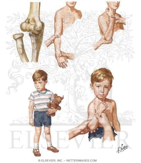 Watermarked preview of unlabeled image: Dislocation and Subluxation of the Radius