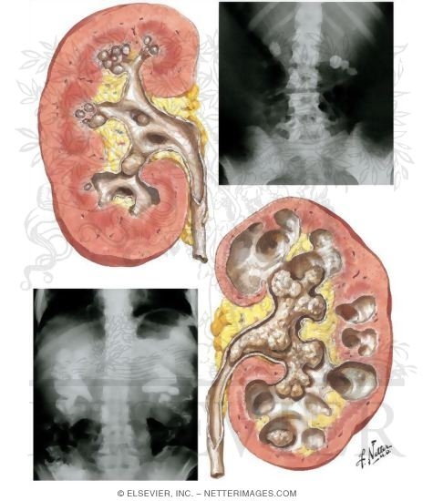 Renal Calculi