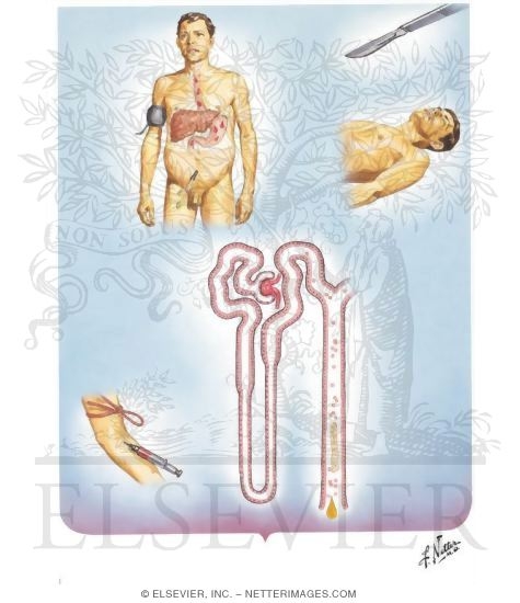 Renal Failure in Liver Disease