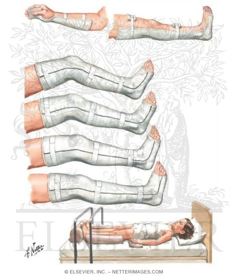 Watermarked preview of unlabeled image: Splints to Rest Inflamed Joints and Correct Deformities