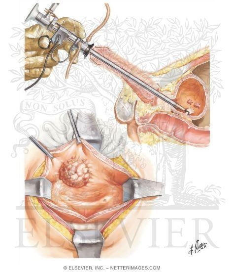 Watermarked preview of unlabeled image: Tumors of the Bladder