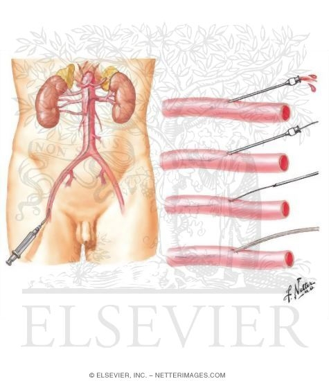 Aortorenal and Selective Renal Angiography (Transfemoral Approach)