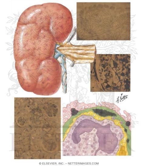 Watermarked preview of unlabeled image: Renal Vein Thrombosis