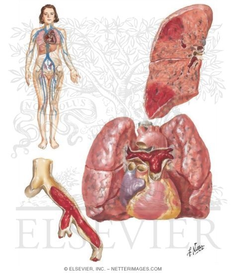 Acute Cor Pulmonale