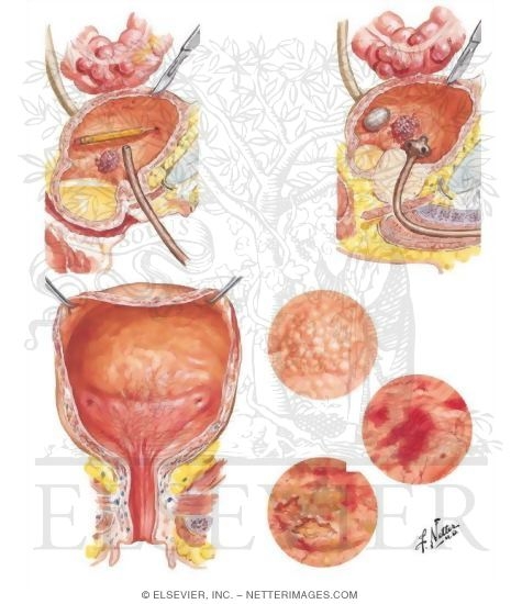 Watermarked preview of unlabeled image: Factors in Etiology of Cystitis