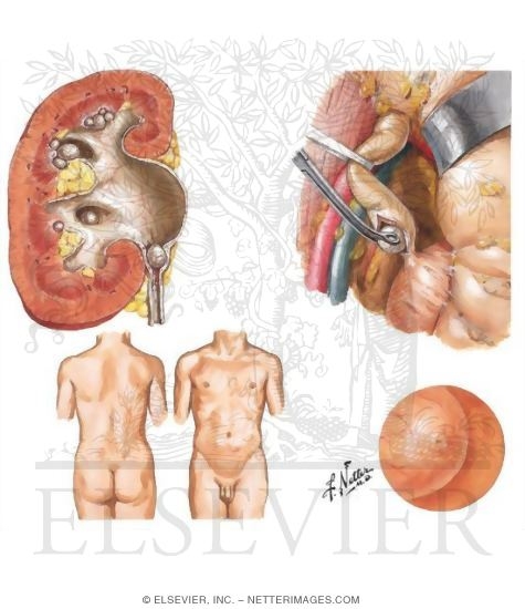 Watermarked preview of unlabeled image: Urinary Tract Calculi