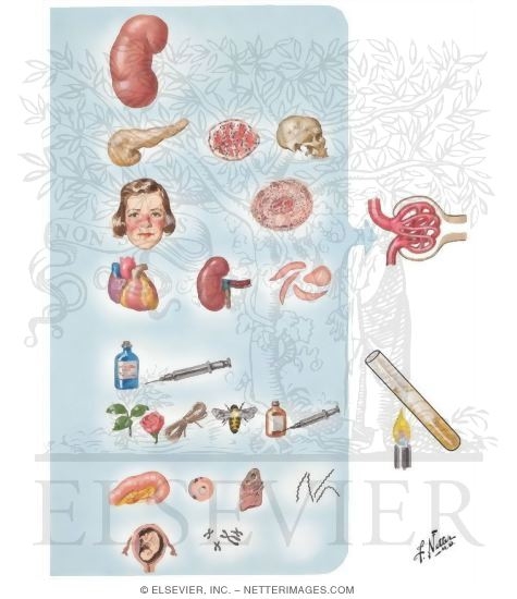 Watermarked preview of unlabeled image: Multiple Etiologies of Nephrotic Syndrome