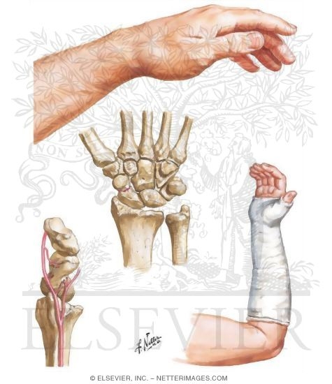 Fracture of the Scaphoid (Navicular)