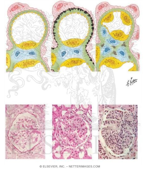 Pathology of the Nephrotic Syndrome