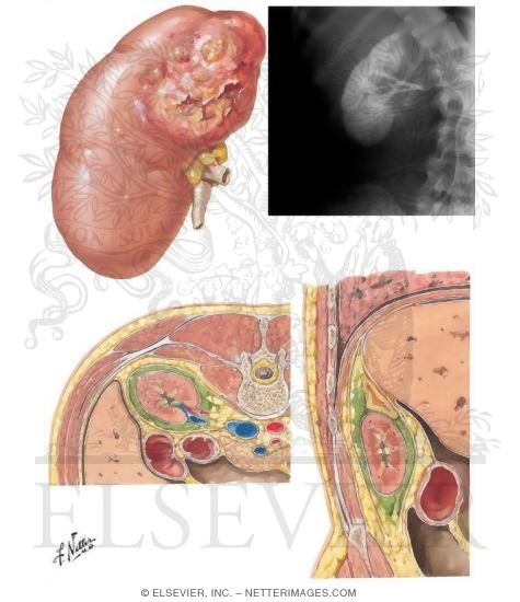 Renal Carbuncle and Perirenal Abscess