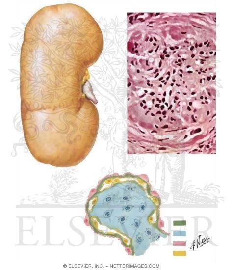 Chronic Glomerulonephritis